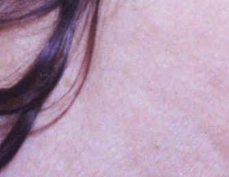 NECK AFTER DERMAGEN